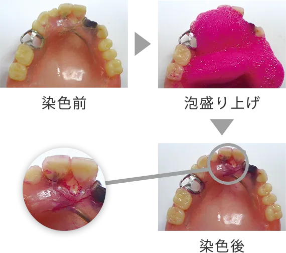 義歯チェック